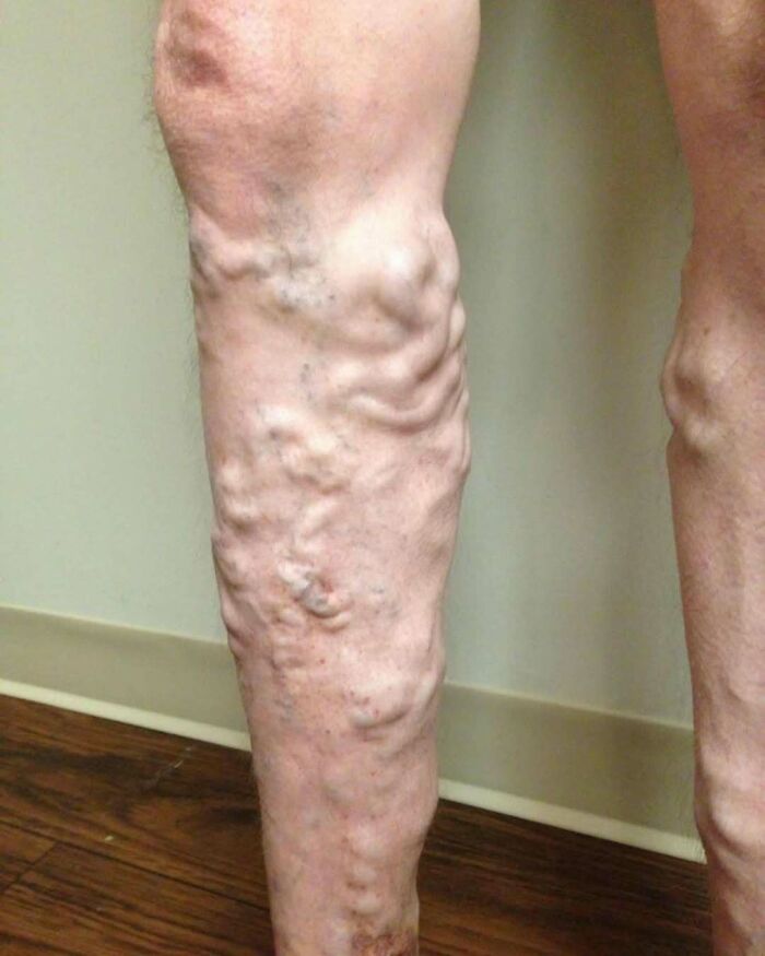 Close-up of a leg showing severe varicose veins, an unnerving medical condition affecting blood vessels.