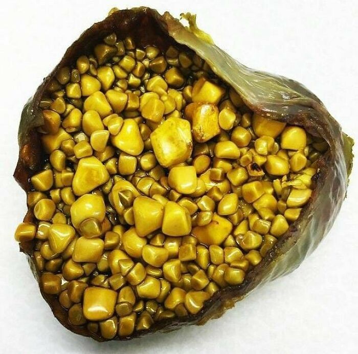 Close-up of a gallbladder surgically removed, filled with numerous yellow gallstones in a fascinating medical pic.