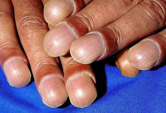 Close-up of fingernails showing medical condition details in a fascinating and unnerving medical pic.