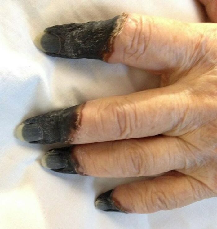 Severe blackened fingertips showing necrosis in a close-up image from fascinating and unnerving medical pics.