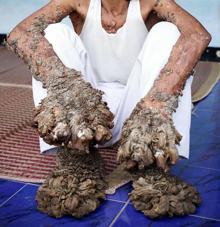 Man sitting with severe skin condition causing large, thick growths on hands and feet in unsettling medical pics category