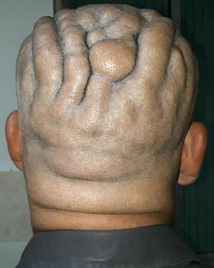 Close-up of a person's scalp with large, unnerving medical skin deformities, showcasing fascinating medical pics for processing.