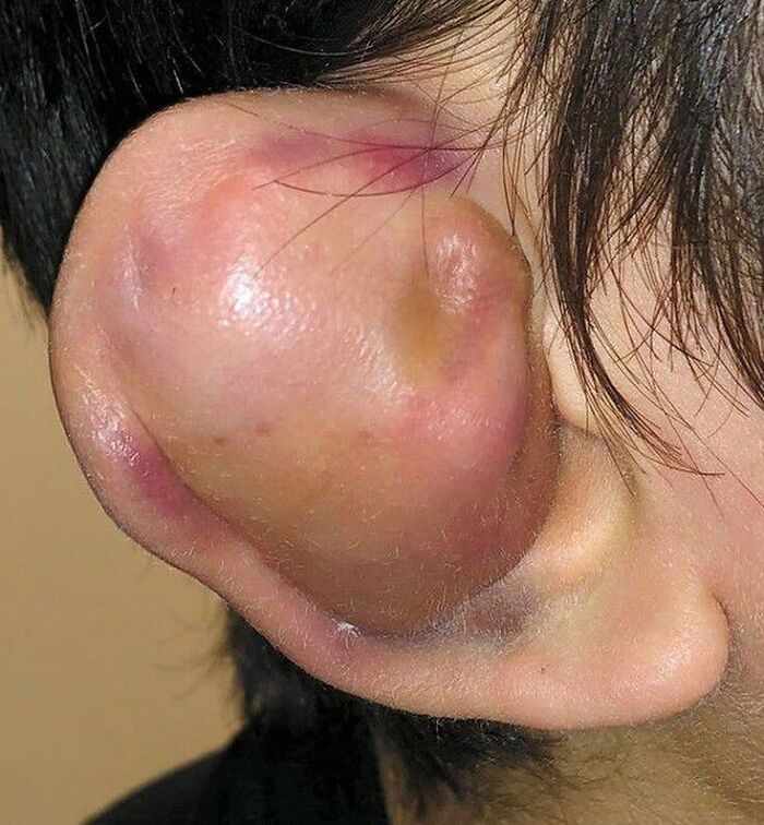 Close-up of a swollen ear with a large cyst, highlighting one of the fascinating and unnerving medical pics.