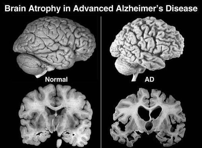 Comparison of brain scans showing normal brain and brain atrophy in advanced Alzheimer's disease, medical pics to process.