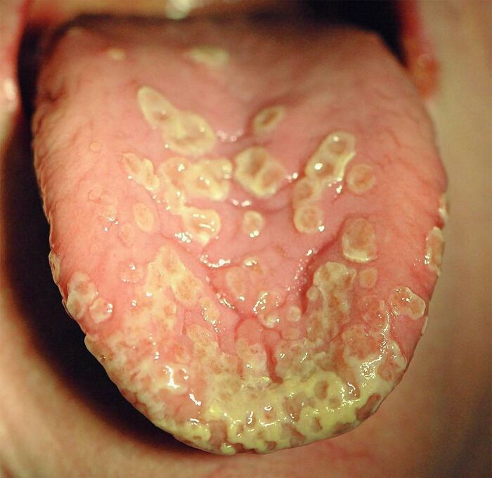 Close-up of a tongue with severe lesions and white patches showing an unnerving medical condition.