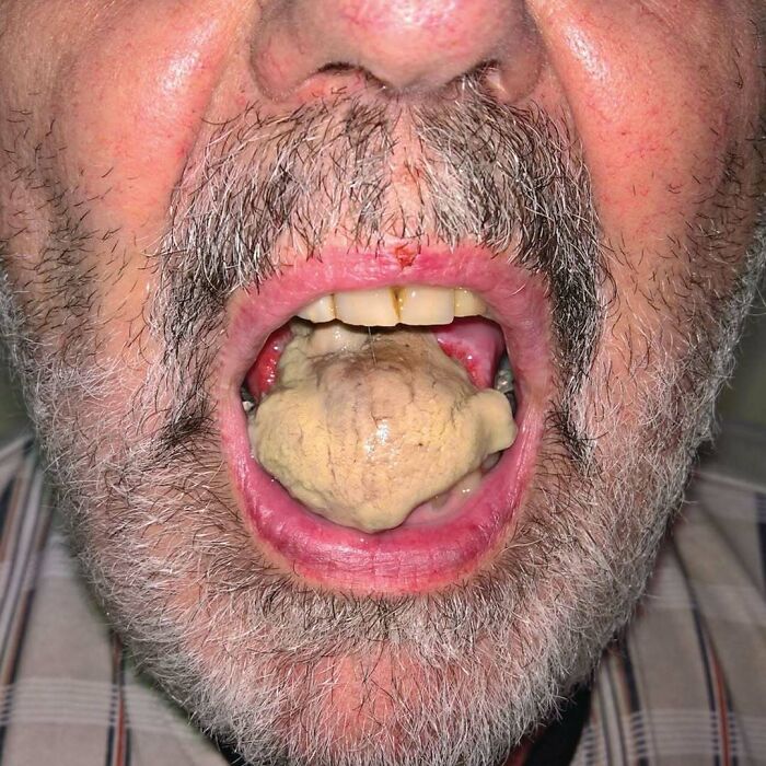 Close-up of a man's mouth with an unusual large tongue condition in one of 80 fascinating and unnerving medical pics.
