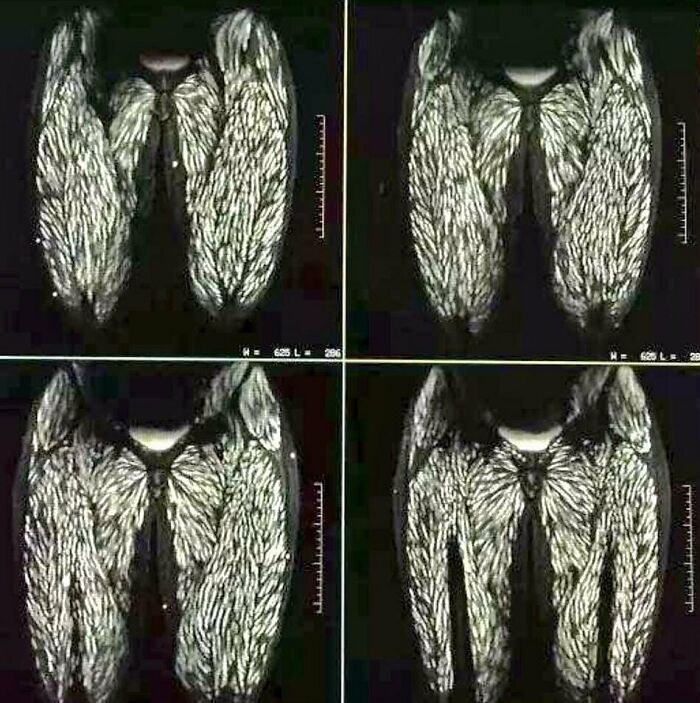 MRI scans showing detailed muscle structure of human upper legs and hips in a medical imaging session.