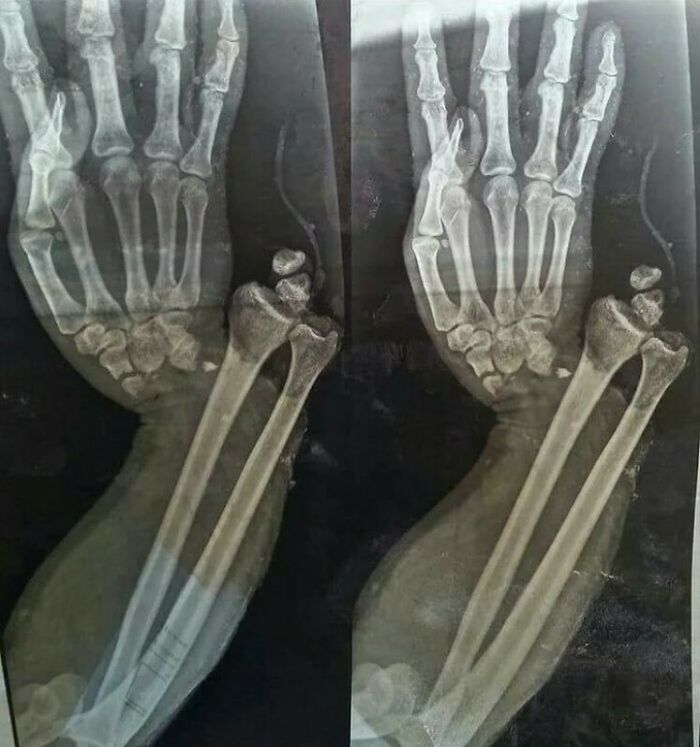 X-ray image showing fractured and misaligned bones in the forearm and hand, a fascinating and unnerving medical pic.