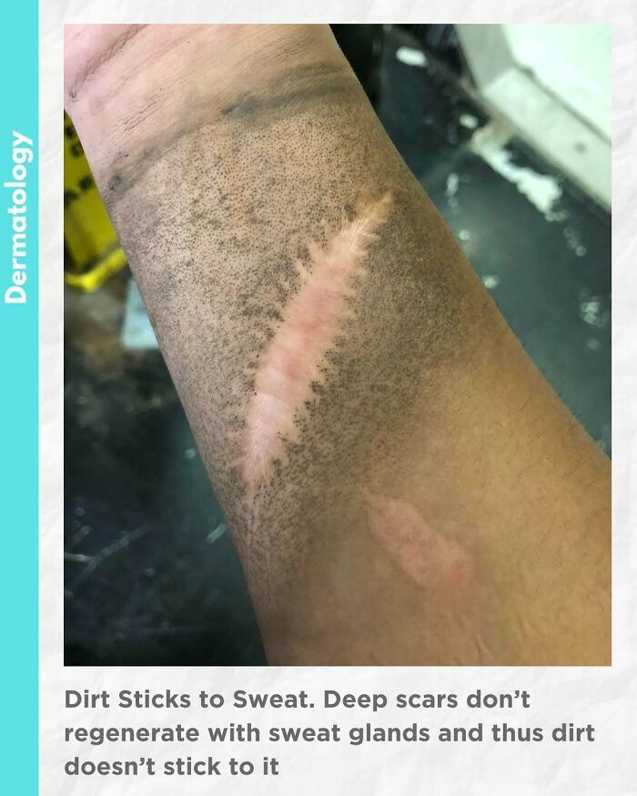 Close-up of arm showing deep scar without sweat glands surrounded by dirt, illustrating fascinating medical scar details.