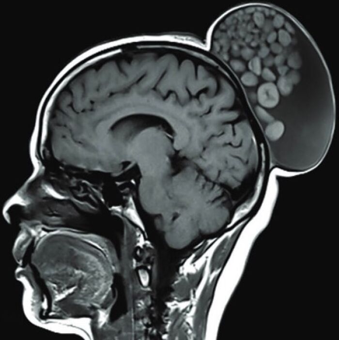 MRI scan of a human brain showing an abnormal growth behind the head in an unnerving medical pic.
