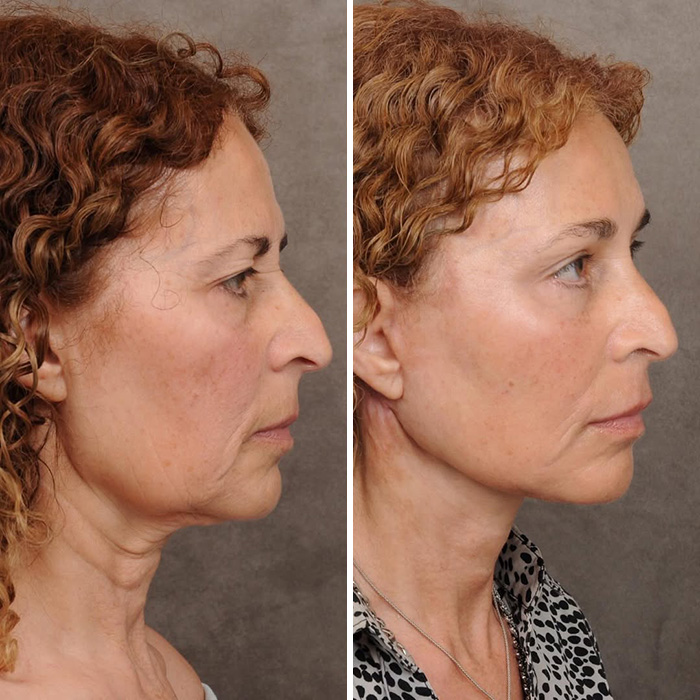 Plastic Surgeon Goes Viral After Dry Response To Facelift Critic Leaves Internet Laughing Hard Plastic Surgeon Goes Viral After Dry Response To Facelift Critic Leaves Internet Laughing Hard