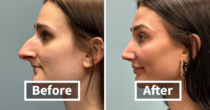 41 Striking Before-And-After Photos Of Plastic Surgery That Seriously Changed People’s Looks