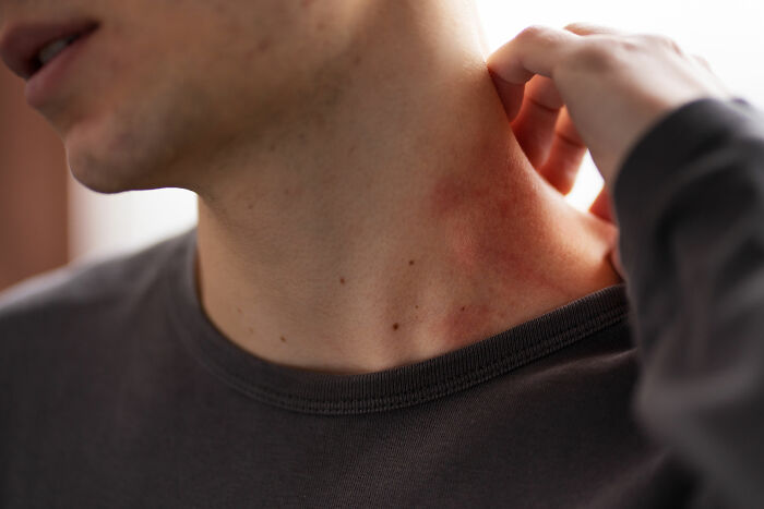 Person scratching red irritated skin on neck illustrating reactions discussed by medical professionals about anti-vaxxer encounters