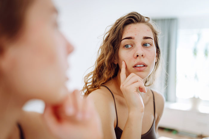 Young woman with acne examining her skin in the mirror, reflecting common concerns about women's bodies and skin health.