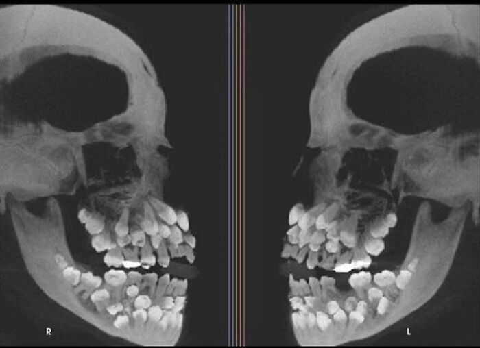 Dental X-ray showing dozens of extra teeth in upper and lower jaws, a shocking woke up expecting surprise