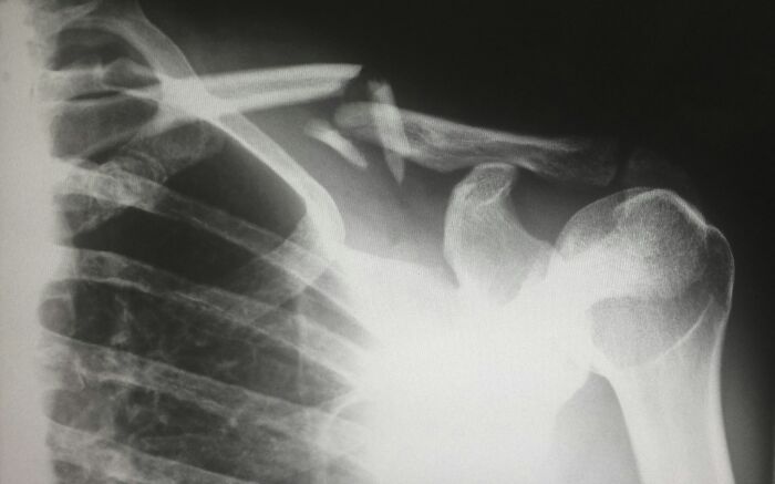 X-ray image showing a broken clavicle, relevant to examples of a doctor doing something unethical with a patient.