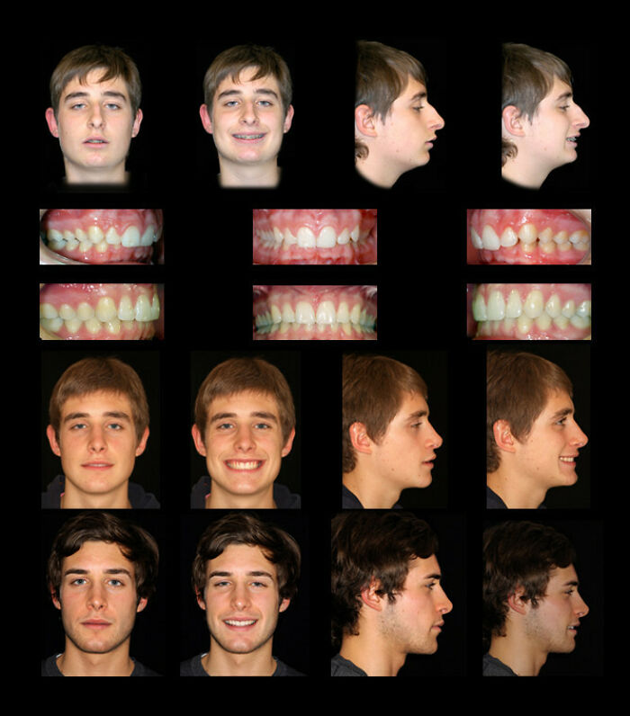 Before and after dramatic orthodontic photos showing front and side views of three young men's teeth and smiles.