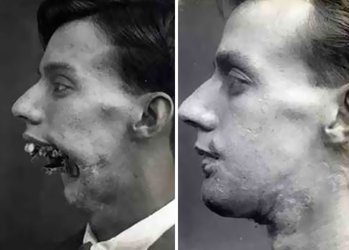 Side-by-side dramatic before and after pics showing a man’s significant facial reconstruction and recovery transformation.