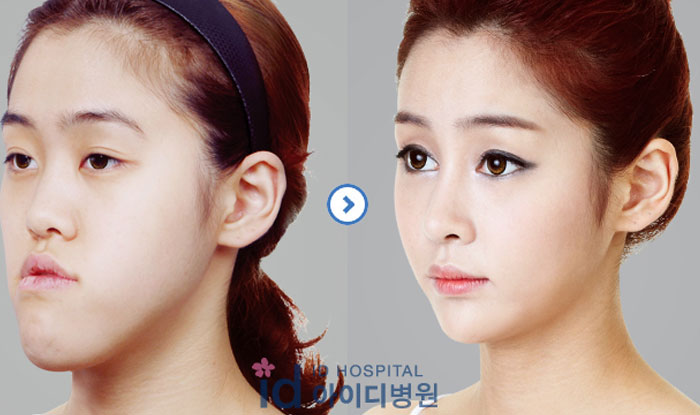 Side-by-side dramatic before and after pics of a woman's facial transformation showcasing significant aesthetic improvements.