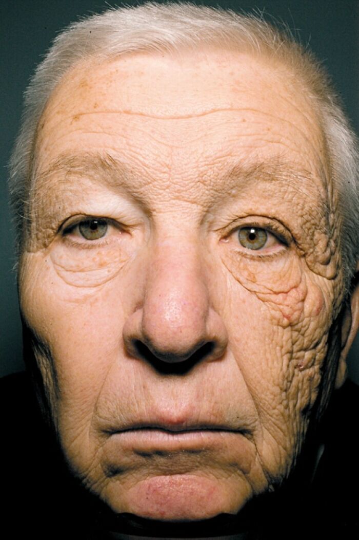 Close-up portrait showing dramatic before and after skin aging differences on an elderly man's face.