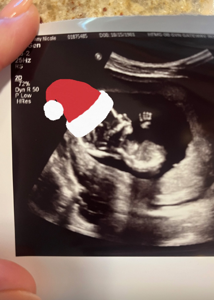 Ultrasound image of a fetus with a digitally added Santa hat, related to fertility clinic mix-up lawsuit. Ultrasound image of a fetus with a digitally added Santa hat, related to fertility clinic mix-up lawsuit.