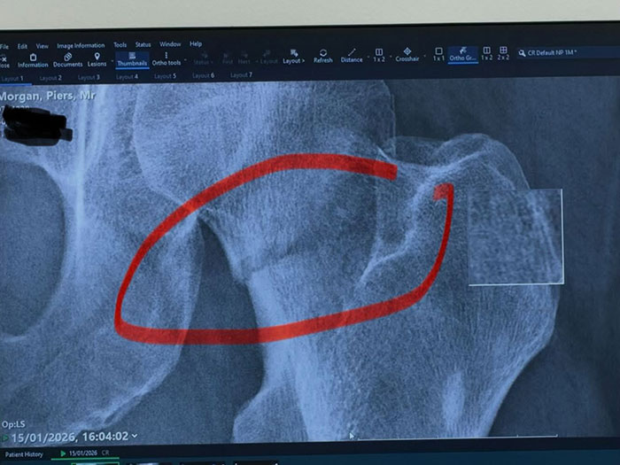 X-ray image showing hip injury with red circle highlighting damage related to Piers Morgan and Donald Trump incident. X-ray image showing hip injury with red circle highlighting damage related to Piers Morgan and Donald Trump incident.