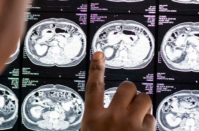 Hand pointing at abdominal CT scans on screen, Saw Images On Google