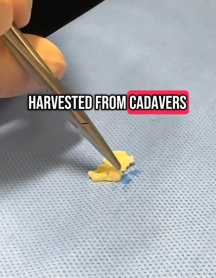 Close-up of surgical tool holding tissue on blue medical cloth with text about donated lifeless bodies for BBLs and breast implants.