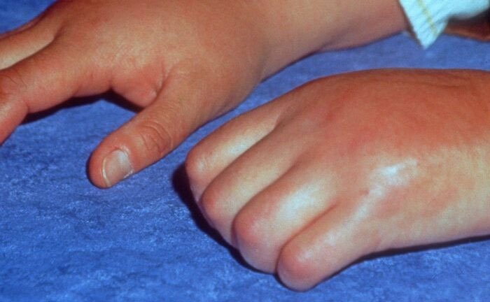 Hands showing signs of a heartbreaking medical condition with swelling and skin discoloration, representing incurable illness.