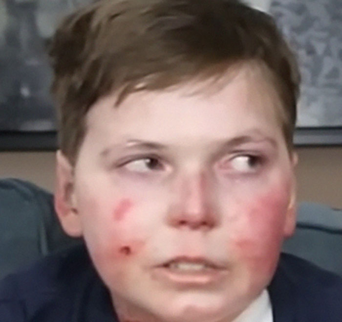 Young boy with visible red rash and skin irritation on face, illustrating heartbreaking medical conditions that can't be cured.
