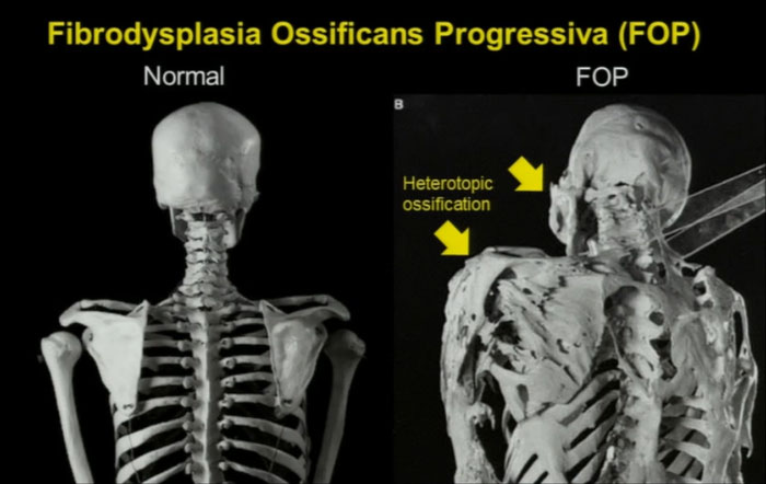 Comparison of normal skeleton and Fibrodysplasia Ossificans Progressiva (FOP) showing heterotopic ossification in an incurable medical condition.