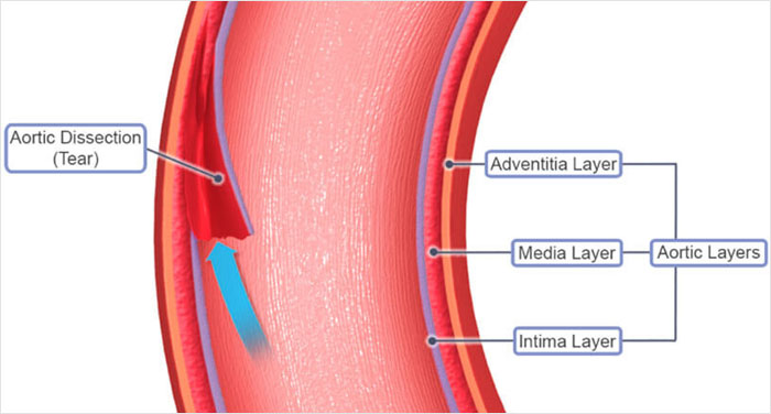 Cross-section of an aorta showing layers and aortic dissection tear, illustrating a heartbreaking medical condition that can't be cured.