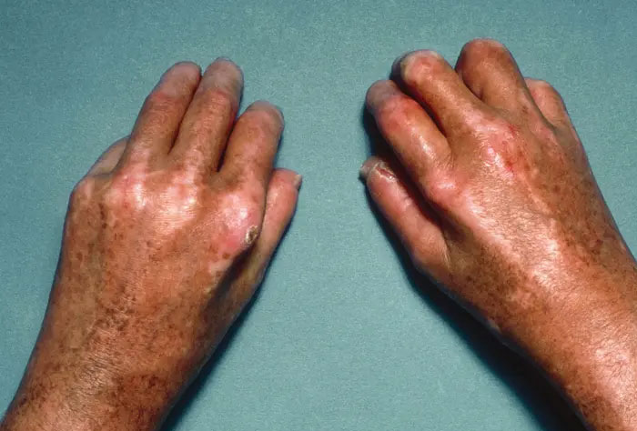 Hands showing severe skin condition with dark patches and scarring, illustrating heartbreaking medical conditions that can’t be cured.