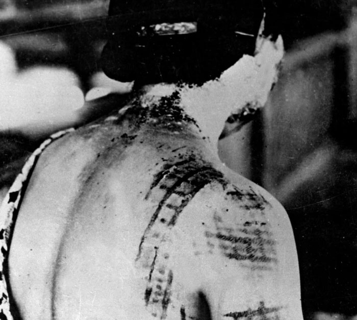 Black and white photo showing severe skin condition with scarring on a person’s back, illustrating heartbreaking medical conditions.