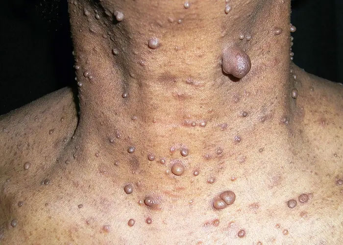 Close-up of skin with multiple raised growths illustrating heartbreaking medical conditions that can’t be cured.