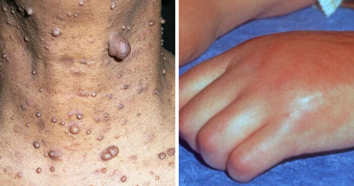 People Are Sharing The Worst Diseases They Know And These 38 Are Truly Horrible