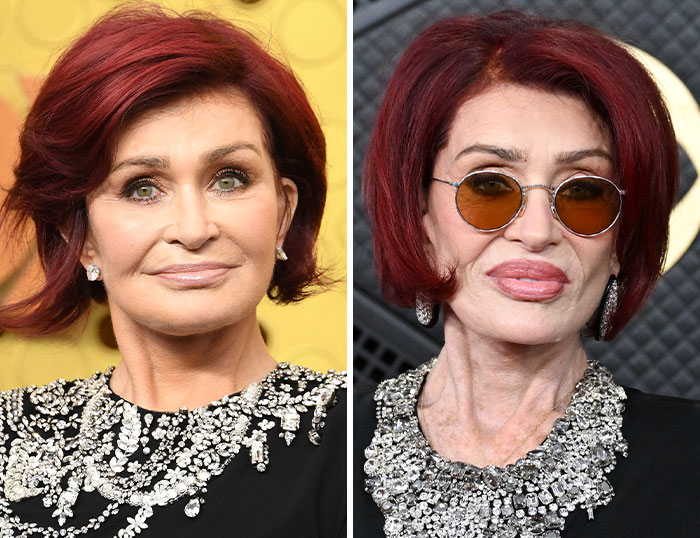 &ldquo;How Is This Possible?&rdquo;: Frenzy Over Botched Plastic Surgery And Weight Loss After The Grammys